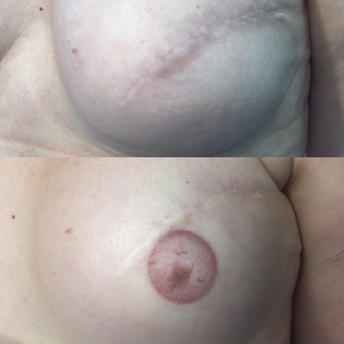 3D Areola Tattoo